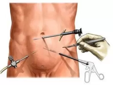 оперативне лікування хронічного простатиту